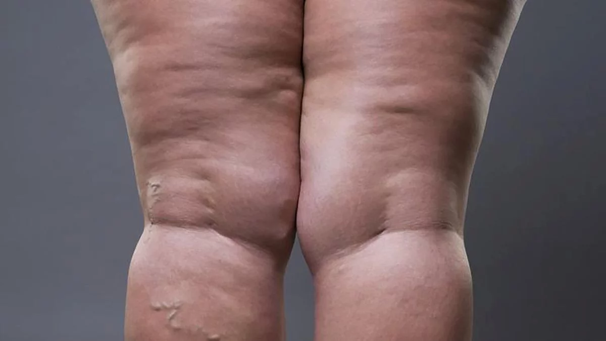 tratamiento para lipedema