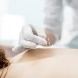 acupuntura